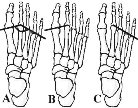 Figure 2.5. A) Meschan angle of right foot formed by: B) une of first and second metatarsals bones and C) line of second and fifth metatarsals.