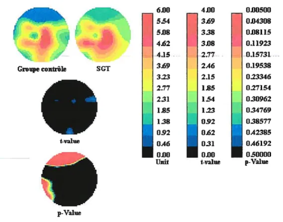Figure 10. Amplitude P300 — comparaison entre les groupes contrôle et SGT dans la condition