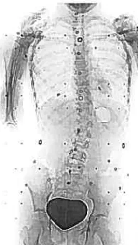 Figure 1-3 Radiographie vue de dos d’une patiente ayant une courbure de type thoraco-lombaire droite [Source: Centre d’évaluation des pathologies du rachis, Hôpital Sainte-Justinel.