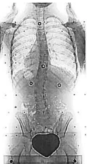 Figure 1-5 Radiographie vue de dos d’une patiente ayant une courbure de