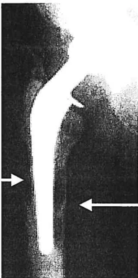 Figure 5. Radiographie d’un patient avec déscettement de prothèse de hanche. Les flèches représentent tes zones cl ‘ostéotyse périprosthétiqzte