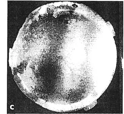 Figure 8. Usure du polyéthylène. Composante de swface acétabulaire en polyéthylène montrant une usure iinportctnte.