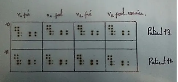 Figure  4.  Exemple  du  résultat  du  dosage  par  la  méthode  semi-quantitative,  Custom  Human 