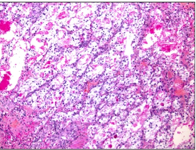 Figure 1. Image histologique du carcinome rénal à cellules claires. 