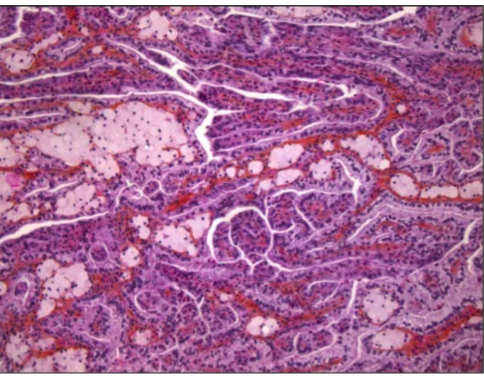 Figure 2. Image histologique du carcinome papillaire sous-type 1. 