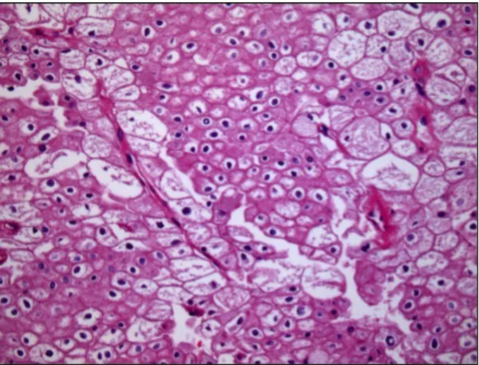 Figure 3. Image histologique du carcinome chromophobe 
