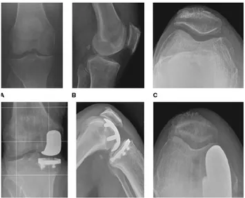 Figure 9 – Prothèse unicompartimentale médiale chez un patient avec une arthrose  médiale isolée du genou 