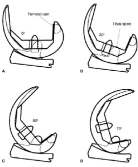 Figure 16 – Prothèse totale de genou postéro-stabilisée 