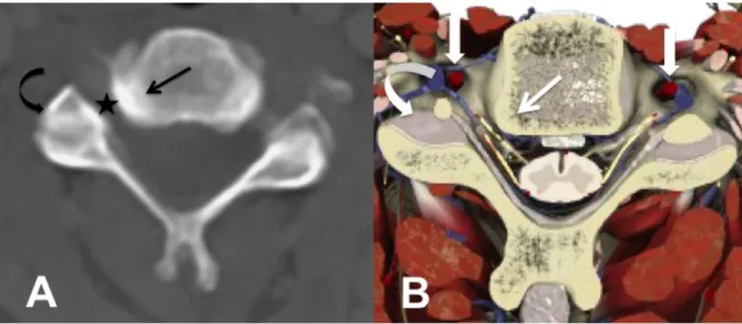 Figure 3. Intervertebral foramen.  