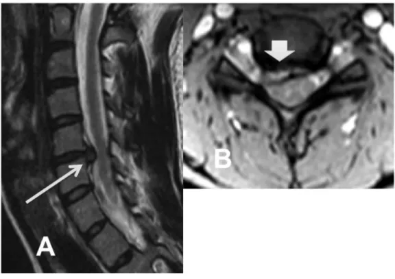 Figure 8. Magnetic resonance imaging of a cervical disc herniation. 