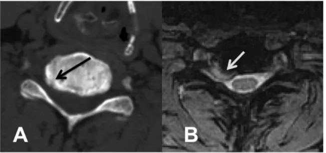 Figure 9. Combination of disc herniation and spondylosis. 