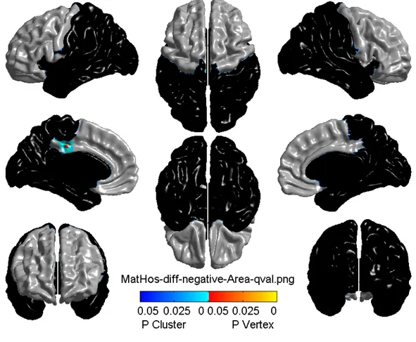Figure 3.1 illustrates the region of posterior-cingulate gyrus cortical surface area, represented  by the bright blue-red spot, which was smaller in the 15-year-olds who had experienced a  more hostile maternal parenting at the age of 5 months