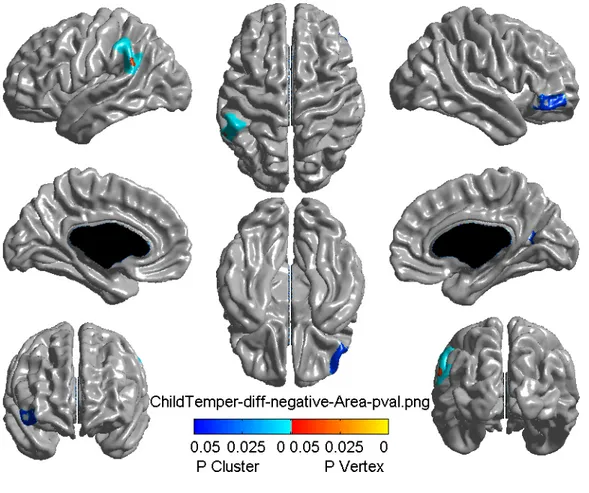 Figure 3.2 illustrates a reduction in right lateral orbitofrontal cortical surface area, represented  by the dark blue spot, in 15-year-olds who had more difficult early temperament at the age of  18 months