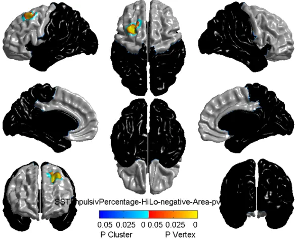 Figure 3.3 illustrates the aspect of left dorsolateral prefrontal cortex where surface area was  reduced, represented by bright yellow-red-blue spots, in 15-year-olds with higher impulsivity  scores, compared with those who got a lower impulsivity score in