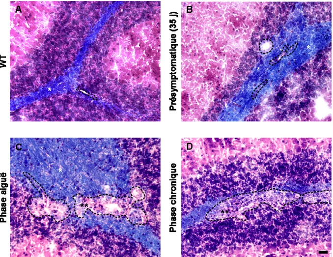 Figure 2. Coloration au LFB/H&amp;E à différents stades d’EAE spontanée.  La coloration au  Luxol Fast Blue, à l’hématoxyline et à l’éosine (LFB/H&amp;E) permet de mettre en évidence la démyélinisation  focale périvasculaire qui apparaît dans la matière bl