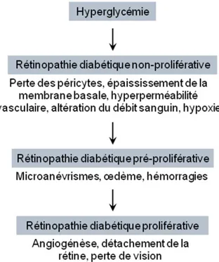 Figure 1.4 : La progression de la rétinopathie diabétique et les altérations vasculaires  associées à chaque stade de la maladie  