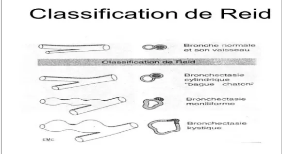 Figure 2 : Classification des DDB selon REID [2,3] 