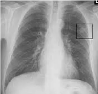 Figure  I : Radiologie du thorax montrant un nodule pulmonaire  b.  Echographie abdominale : 