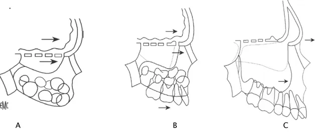 Figure n°27. Croissance maxillaire sagittale. [9]  A. À la naissance. 