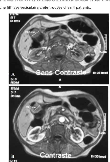 Figure 8 (A et B) : coupes axiales IRM montrant une vésicule biliaire siège d’une formation hypo- hypo-intense sans dilatation des voies biliaires