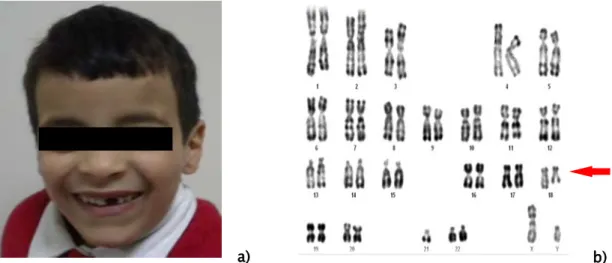 Figure 6: Dérivé du chromosome 9 chez une fille 