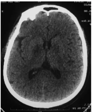 Figure 6 : Infarctus cérébraux bilatéraux localisés   au niveau des capsules internes