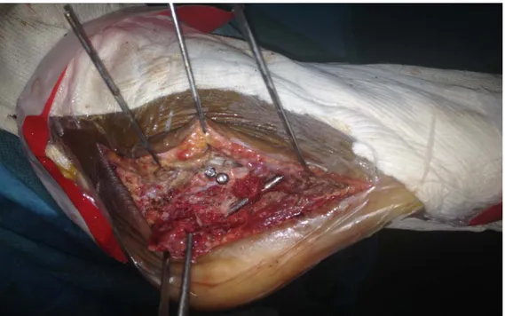 Figure 15: vue opératoire d’une fracture de calcanéus : écartement par des  broches 