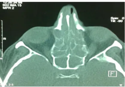 Figure 14 : TDM montrant une PNS avec comblement total des cellules éthmoïdales et du sinus  sphénoïdal