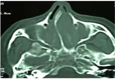 Figure 19 : Déviation de la cloison nasale sur coupe axiale scannographique. 0% 10% 20% 30% 40% 50% 60% 70% 80% 76% 50% 25%  comblement maxillaire = 137  comblement  frontal = 90  comblement sphenoidal = 45  