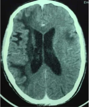 Figure 4: Coupe horizontale d’une TDM cérébrale avec injection :  