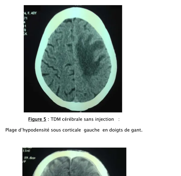 Figure 6 : Coupe horizontale d’une TDM cérébrale avec injection : lésion sous corticale  gauche 