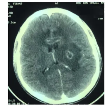 Figure 8 : Coupe horizontale d’une TDM cérébrale avec injection : multiple lésions sous  corticales  avec prise de  contraste annulaire avec œdème périlésionnel