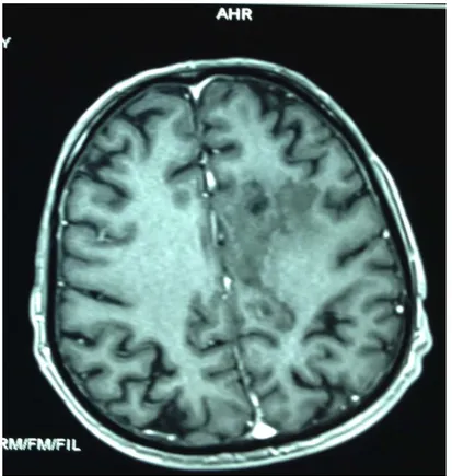 Figure 9 : IRM cérébrale Séquence T1sans injection :   lésion sous corticale  gauche en hyposignal