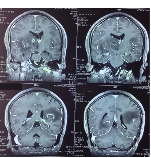 Figure 10 : IRM cérébrale Séquence  T1avec  injection (coupes coronales): plusieurs  lésions  sous corticales  bilatérales en hyposignal avec prise de Gadolinium en cocarde, important 