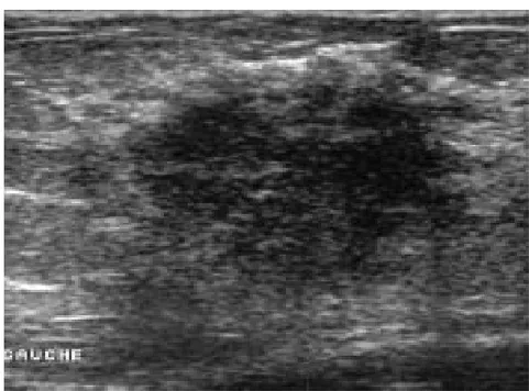 Figure 8 : Masse solide hypoéchogène, d’échostructure hétérogène, contour microlobulé et  spiculé