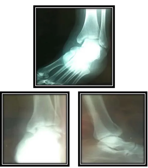Figure N°9 : Fracture incomplète marginale antérieure.  Tableau V: Répartition des fractures complètes  