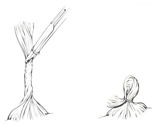 Figure 12 : Schéma des couettes utilisées dans la voie coronale [85]  Etape 2 : traçage de l’incision : (Figure n° 12) 