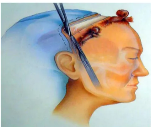 Figure 14: La technique d’incision du scalp dans la région temporale. [85] 