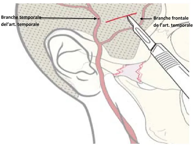 Figure 19: Incision de l’approche de Gillies   par rapport à l’art. temporale superficielle