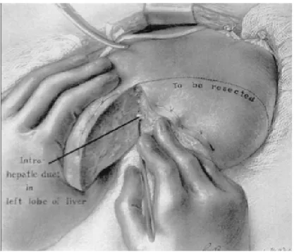 Figure 1: Opération de Longmire: résection hépatique gauche et anastomose d'un canal biliaire  intra hépatique au jéjunum [11]