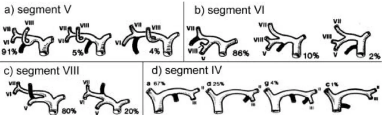 Figure 6 : Représentation schématique des variations d'abouchement des voies biliaires droites  (a, b, c) et gauches (d) [21]