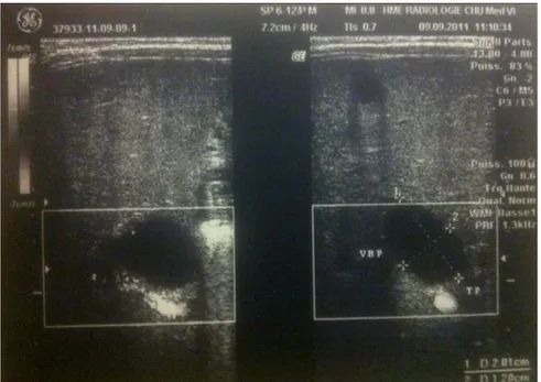 Figure 16: Echographie abdominale chez un nourrisson de 2 mois objectivant un kyste hilaire  (2cm/1,2cm de diamètre)