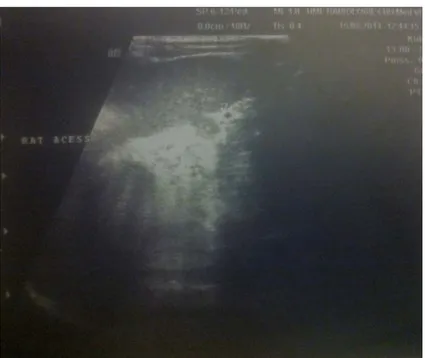 Figure 17: Echographie abdominale chez un nourrisson de 4 mois objectivant une rate  accessoire