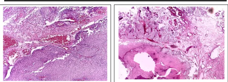 Figure 16 : Images d’un carcinome urothélial stade pTa de bas grade.  (Coloration HES, obj x 10)