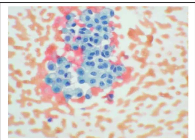 Figure 21 : Une image de cytologie urinaire de notre étude objectivant un  carcinome   urothélial de bas grade.