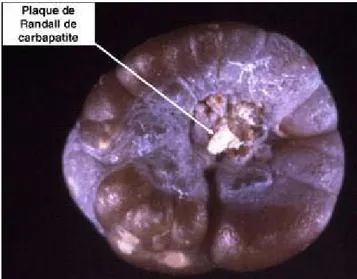 Figure 7 : Calcul de whewellite formé sur la papille rénale à partir d’une plaque de Randall(11)