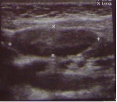 Figure 8: Echographie cervicale montrant une image kystique à contours festonnés et à contenu  hétérogène avec un diamètre de 28 mm 