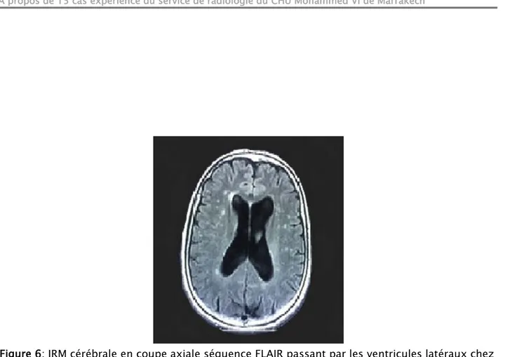 Figure 6: IRM cérébrale en coupe axiale séquence FLAIR passant par les ventricules latéraux chez  une patiente âgée de 60 ans présentant des céphalées avec abolition des ROT