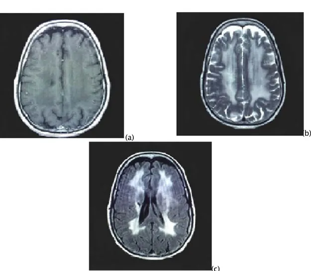 Figure 7 : IRM cérébrale en coupes axiales T1 avec gadolinium (a), T2 (b) et FLAIR (c) passant par  les ventricules et les centres semi ovales chez une patiente âgée de 52 ans, présentant des  troubles de l’humeur avec des troubles psychotiques