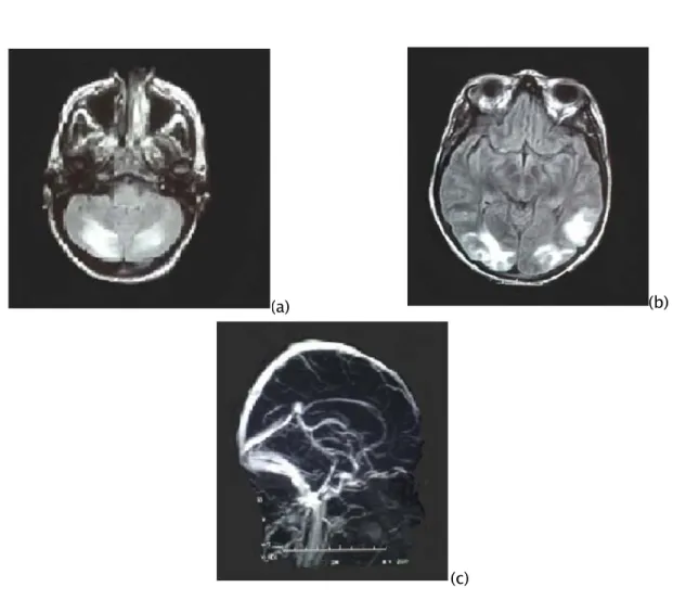 Figure 10 : IRM cérébrale en coupes axiales FLAIR passant par l’étage sous tentoriel (a), et sus  tentoriel (b) et en séquence angioIRM veineuse (c) réalisée chez une patiente âgée de 33 ans, 